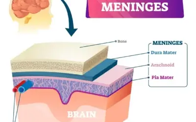 glioblastoma, gbm, leptomeningeal metastases, leptomeningeal cancer, leptomeningeal disease